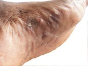 Athlete's foot tinea