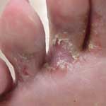 Athlete's foot