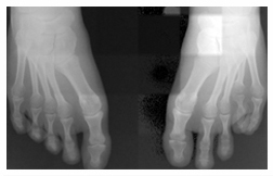 X-Ray Showing Brachymetatarsia on Fourth Toe on Left Foot