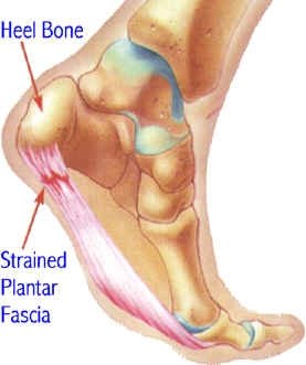 Foot anatomy showing heel bone and strained plantar fascia