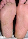 Fungal foot infection