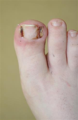 Ingrown Toenail on big toe