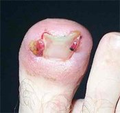 Close up of Ingrown toenail