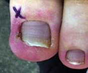 Ingrown toenail on big toe