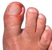 Ingrown Toenail