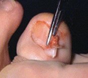 Removing Part of Ingrown Toenail