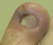 Ingrown Toenail