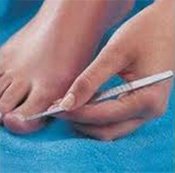 Ingrown Nail