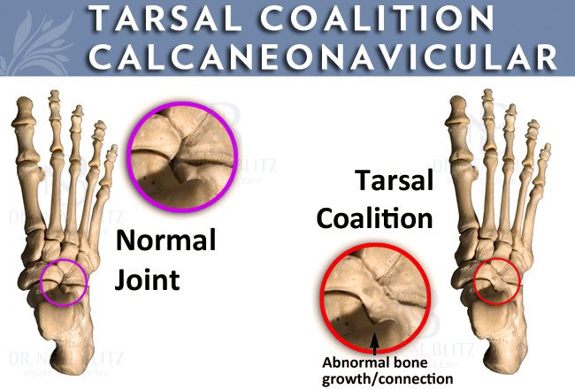 Normal Joint vs Tarsal Coalition - Abnormal Bone Growth/Connection