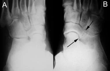 X-Ray Showing Tarsal Coalition